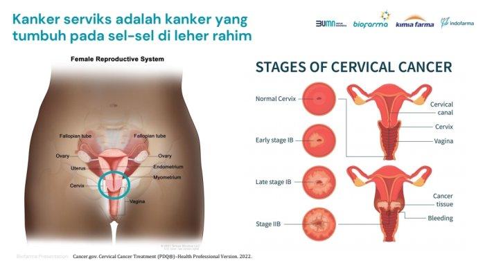 Ilustrasi kanker serviks