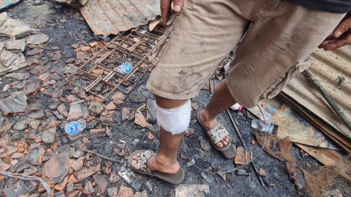 Ibrahim Muhamad Idris (43) mengalami luka bakar usai membantu memadamkan api yang melumat permukiman warga di Cikini Keramat, Pegangsaan, Menteng, Jakarta Pusat pada Selasa (27/9/2022).
