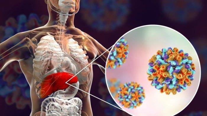 Ilustrasi hepatitis akut.