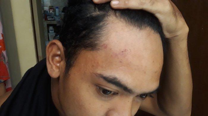 Indra Hatta (31), korban dugaan penganiayaan dilakukan oknum anggota TNI AD saat menunujukkan bekas luka akibat dianiaya, Kramat Jati, Jakarta Timur, Jumat (20/8/2021).