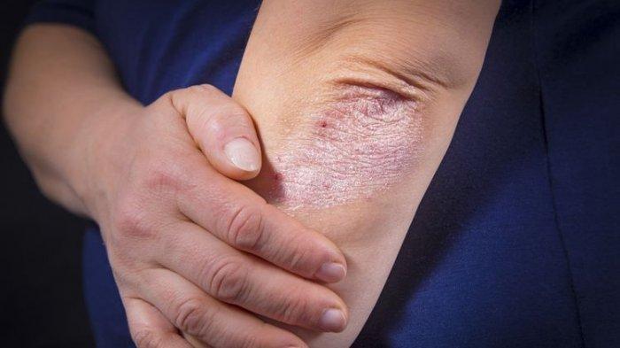 ILUSTRASI manfaat bawang putih untuk atasi psoriasis.