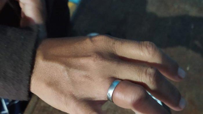 Kondisi jari Dewi, warga Tebo Tengah.