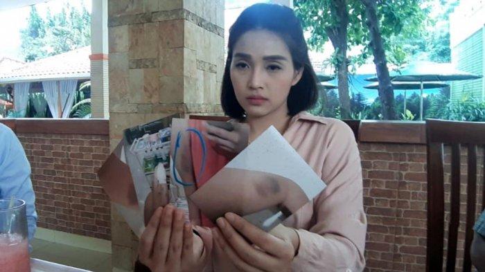 Jessica Wardhana, korban kekerasan dalam rumah tangga (KDRT) dari kakak kandunganya sendiri ketik menunjukkan foto penganiayaan yang dia alami, Senin (1/2/2021).