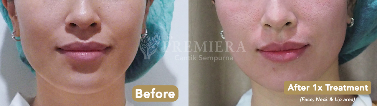 Before after lips rejuvenation