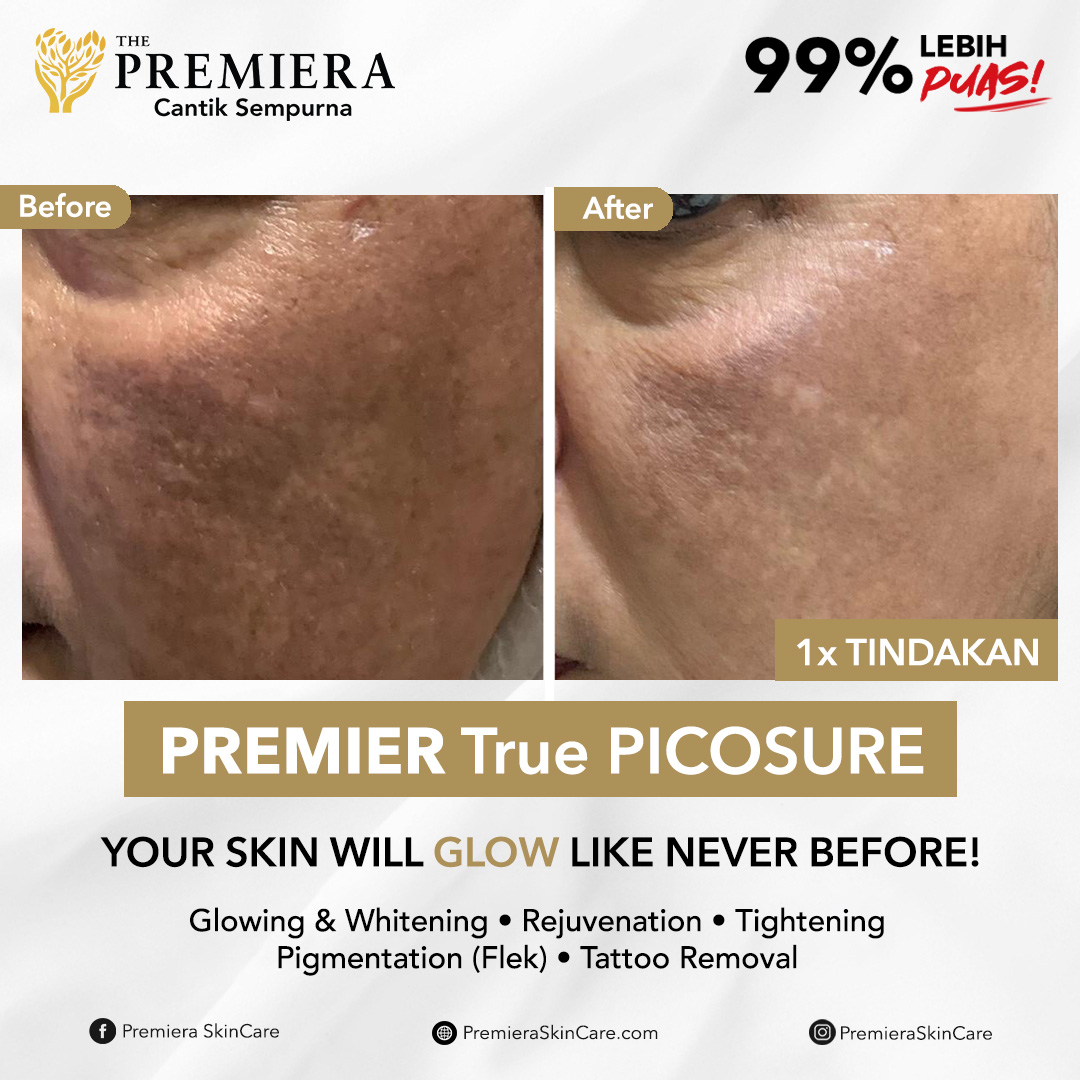 PREMIER True Picosure