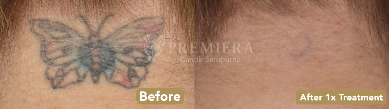 PREMIER True PicoSure sebagai alternatif lips embroidery