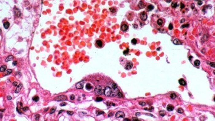 Virus Nipah yang ditemukan pada paru-paru babi di Malaysia (Peter Hooper/CSIRO/Wikimedia via Kompas.com)