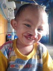 Balita Penderita Bibir Sumbing di Jeneponto Butuh Bantuan Dermawan