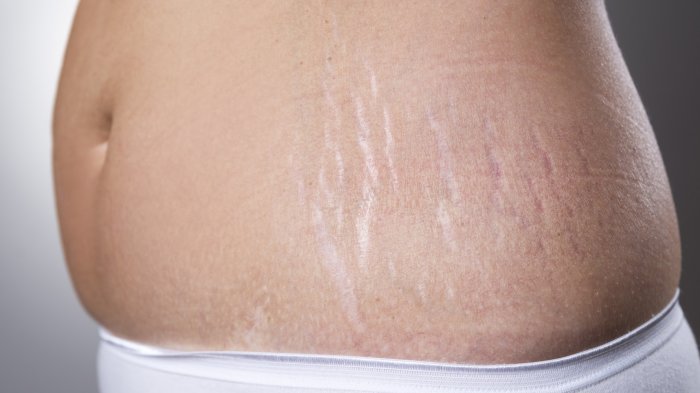 Ilustrasi Stretch Mark