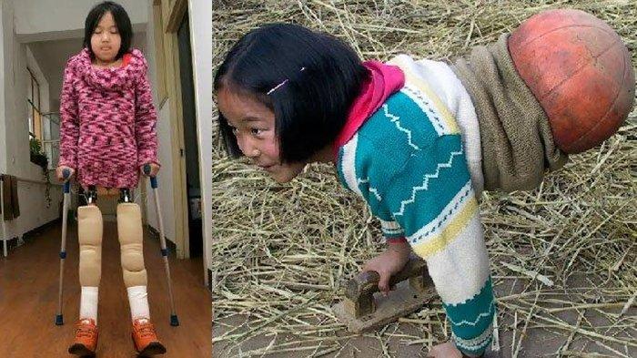 Kisah menginspirasi dari seorang gadis dari China bernama Qian Hongyan. Dulu berjalan dengan alat bantu bola basket, kini Qian sudah bisa berdiri tegak.