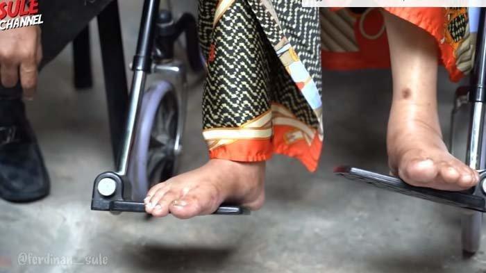 Kondisi kaki Dorce Gamalama yang bengkak.