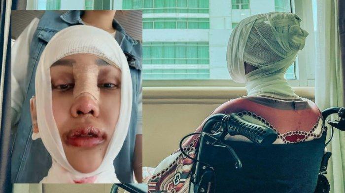 Lucinta Luna Pasca Operasi Pemotongan di Bagian Leher