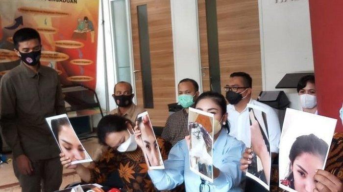 Penyanyi Nindy Ayunda menunjukkan foto-foto lebam pada wajahnya akibat kekerasan dari suaminya, Askara Parasady, di kantor Komnas Perempuan, Jakarta, Selasa (16/2/2021).(KOMPAS.com/REVI C RANTUNG)