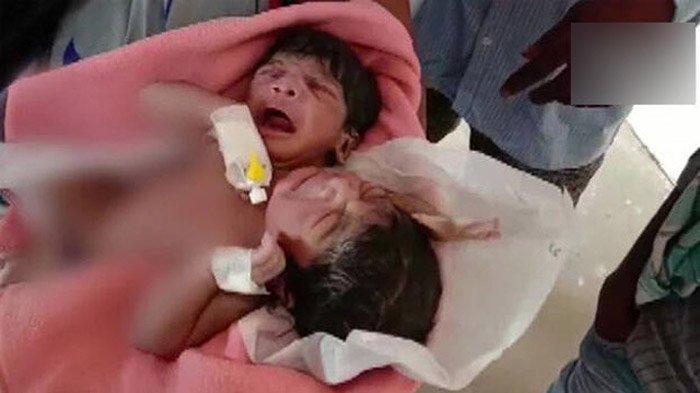 Bayi kembar siam dengan kondisi yang sangat langka lahir dengan dua kepala, tiga lengan dan dua kaki. Ibu bayi tersebut sangat sedih dan pingsan melihat kondisi bayinya.