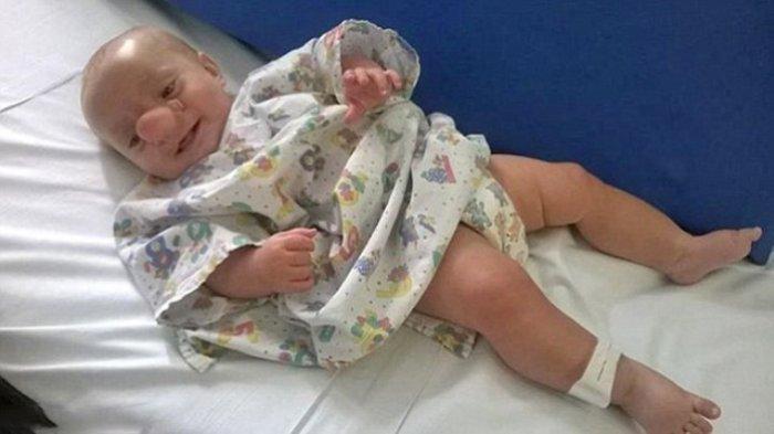 Bayi Ollie lahir dengan kondisi tidak biasa. Ia lahir dengan hidung besar hingga dijuluki Bayi Pinokio.