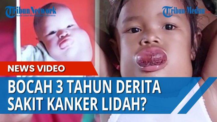 Nabilla bocah perempuan berusia 3 tahun diduga menderita penyakit kanker lidah.
