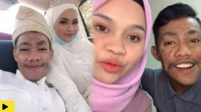 Viral kisah cinta wanita dan laki-laki yang memiliki kelainan di wajah