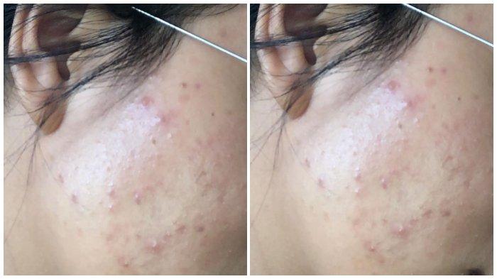 Wajah Mayang kini penuh dengan jerawat