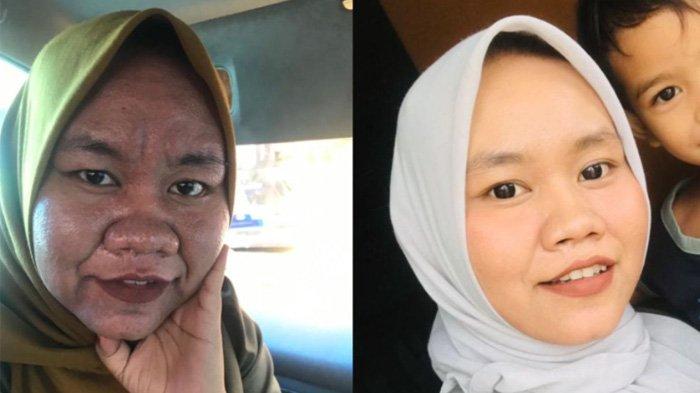 Wajah Nur Husna menjadi keriput dan membengkak saat hamil