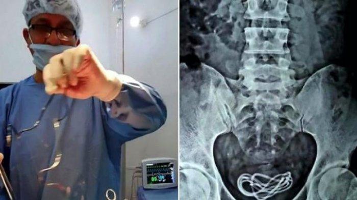 Mengeluh sakit perut, ternyata ada kabel charger HP sepanjang 61 cm di dalam kandung kemih pria ini.