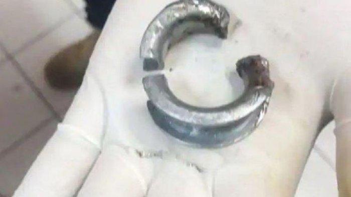 Dokter di Bangkok, Thailand menunjukkan cincin baja yang dipakai seorang pria di alat kelaminnya untuk membuat pacarnya terkesan di hari Valentine. Pria itu harus dirawat di rumah sakit karena penisnya membengkak dan menyebabkannya kesakitan