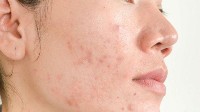Bekas jerawat yang muncul dan susah hilang bisa diatasi dengan menggunakan bahan alami yaitu masker kunyit.
