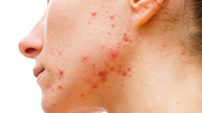 Ilustrasi seseorang dengan masalah jerawat di wajah, bisa terbantu untuk diatasi dengan menggunakan skincare acne yang mengandung Vitamin E.