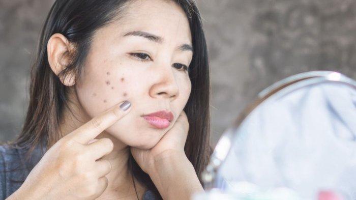 Seorang wanita yang memiliki noda hitam pada wajah dapat diatasi dengan rutin menggunakan buah stroberi.