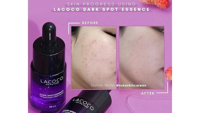LACOCO Dark Spot Essence ampuh melawan flek hitam dengan penggunaan rutin