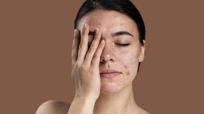 Ilustrasi wanita yang memiliki permasalahan jerawat dan juga noda hitam di wajah.