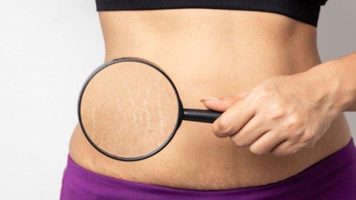 Kemunculan stretch mark akibat peregangan kulit saat masa kehamilan atau pertambahan berat badan yang drastis, bisa diatasi dengan krim yang berformula khusus mengatasi stretch mark.