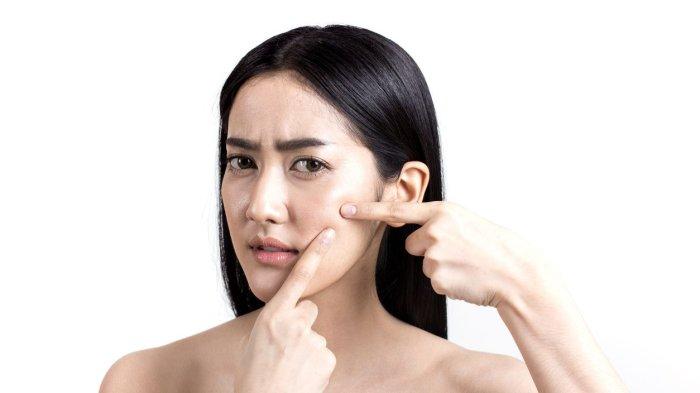 Ilustrasi masalah jerawat di kulit yang bisa dicegah dengan rutin menggunakan skincare dengan kandungan ceramide di dalamnya.