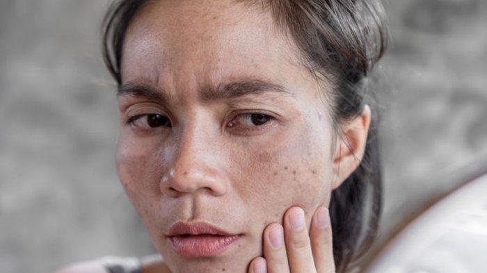 Wanita dengan masalah hiperpigmentasi pada kulit wajah yang membuatnya menjadi kurang percaya diri.