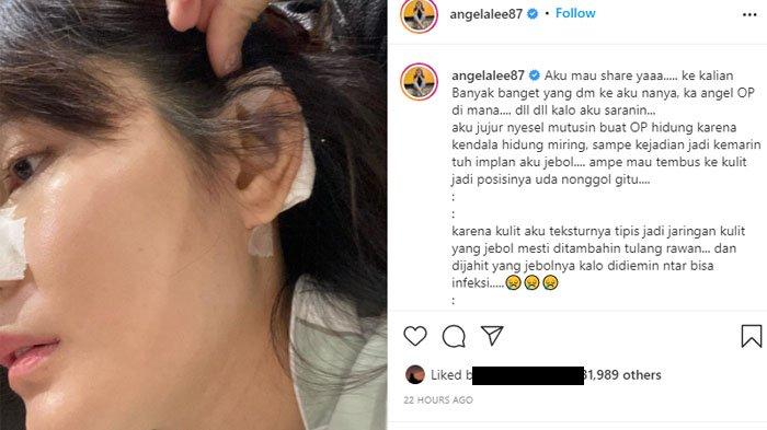 Angela Lee ceritakan kondisinya kini setelah gagal jalani operasi hidung.