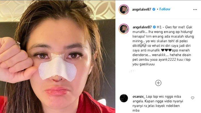 Angela Lee membagikan potret hidungnya yang sedang diperban.