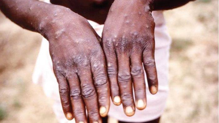 Akibat Virus Cacar Monyet atau monkeypox