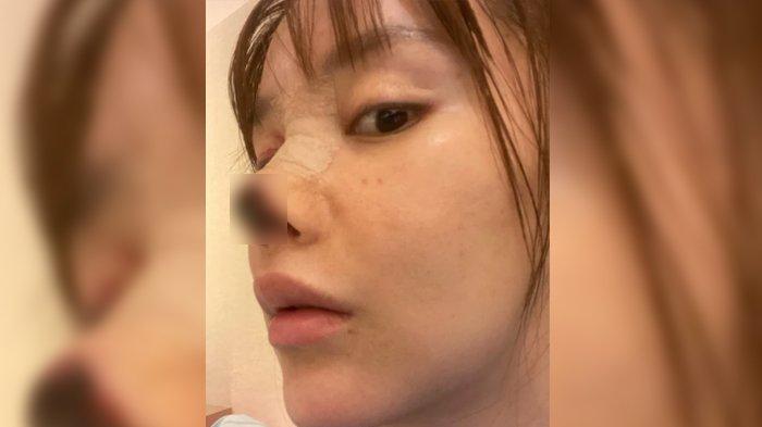 Gao Liu dengan kondisi hidungnya yang menghitam akibat operasi plastik