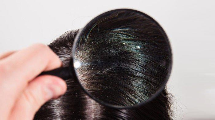 Ilustrasi rambut berketombe