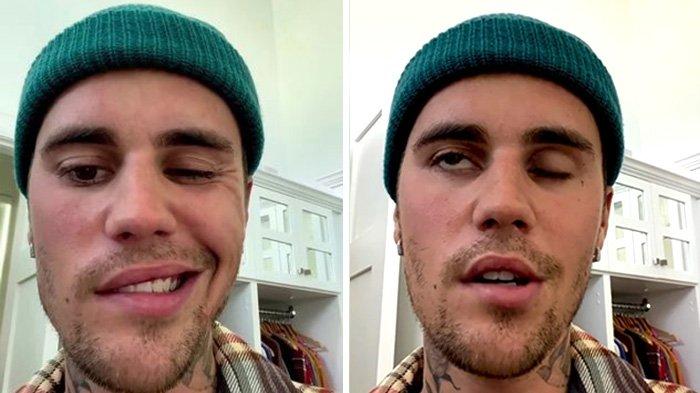Justin Bieber alami sindrom Ramsay Hunt.