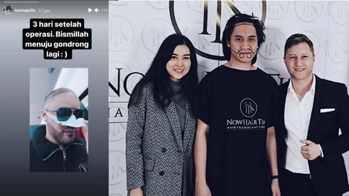 Kevin Aprilio melakukan transplantasi rambut di bagian jidat dan brewok.