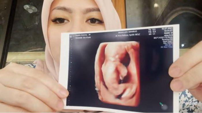 Nathalie Holscher tunjukkan potret USG buah hati.