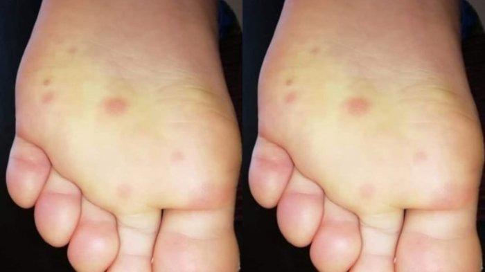 Lesi berwarna ungu dan gejala seperti cacar air ditemukan di sejumlah kasus. -- Penjelasan mengenai monkeypox atau cacar monyet, berikut asal-usul, gejala awal dan cara penyebarannya.