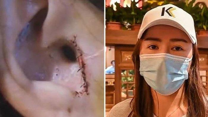 Zhao, wanita muda di China yang operasi hidung justru kehilangan bagian telinganya