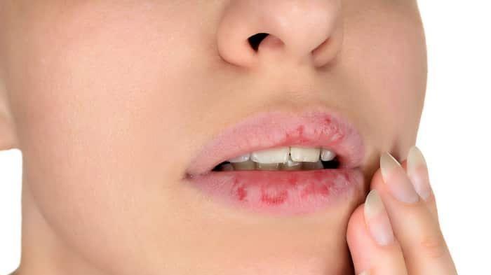 Ilustrasi Bibir Pecah-pecah