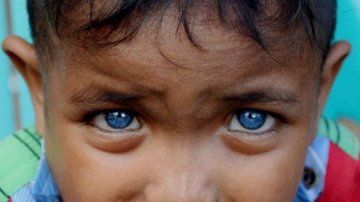 Seorang bocah di Desa Boneatiro, Kecamatan Kapuntori, Kabupaten Buton Sulawesi Tenggara, Fardan Ramadhan (5), memiliki sepasang mata yang berwarna biru di kedua bola matanya.