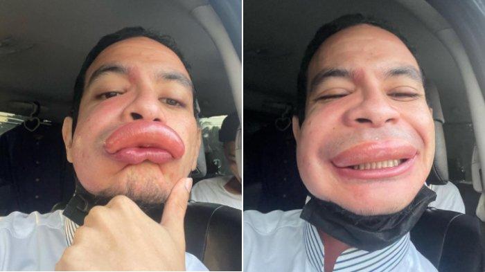 Aktor Malaysia Harris Annuar bibirnya bengkak disengat lebah