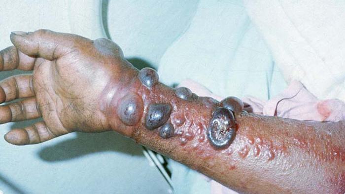 Pasien terpapar virus ebola