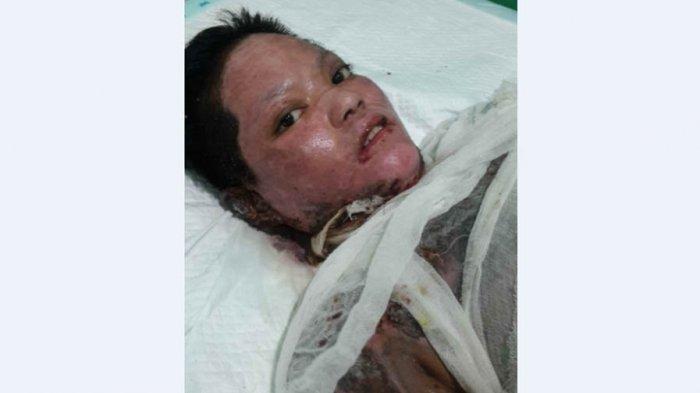 Ibu Muda Dibakar Suami, Kini Terlilit Utang Rp 25 Juta untuk Biaya Pengobatan di 2 Rumah Sakit
