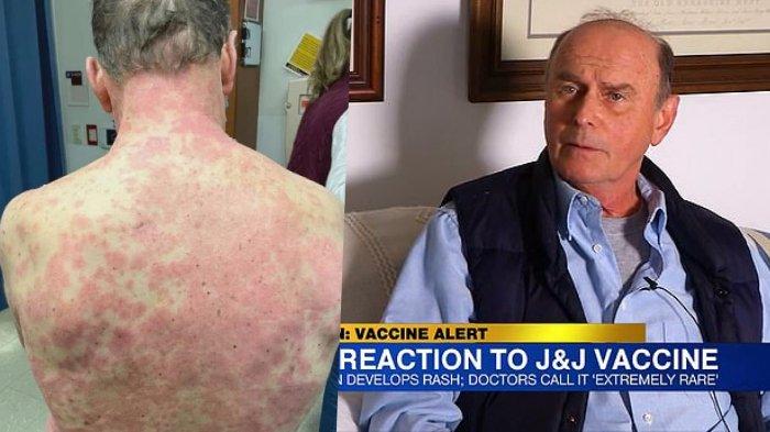 Alami Reaksi Langka setelah Vaksin Covid-19 Johnson & Johnson, Pria di Virginia Masuk UGD