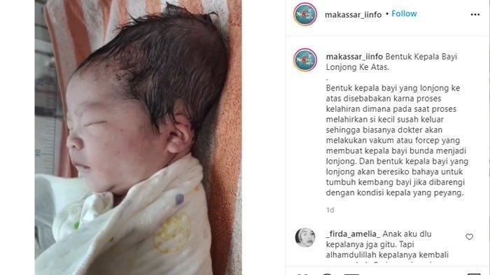 bayi-berkepala-lonjong-akibat-vakum.jpg
